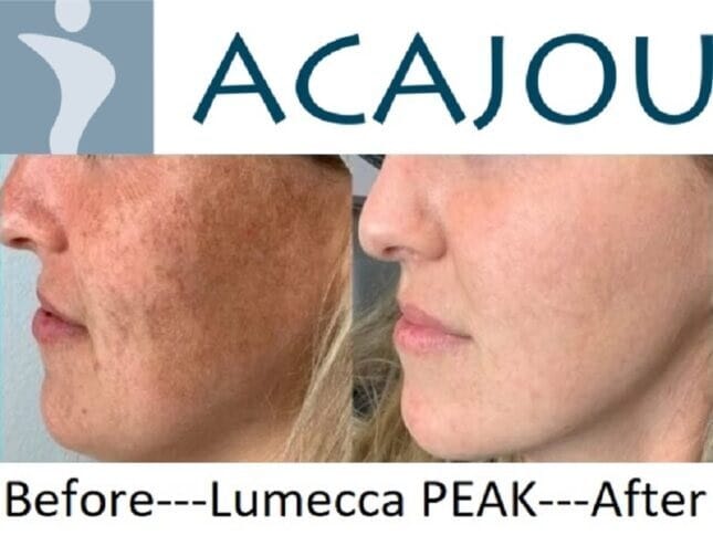 Before and after skin treatment comparison