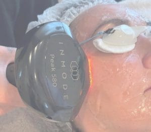 Facial treatment with lLumecca Peak device.