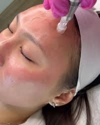Woman receiving facial microneedling treatment